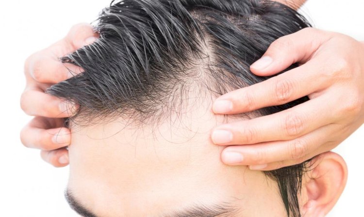 10 Causes of male pattern baldness and tips to reverse or prevent it