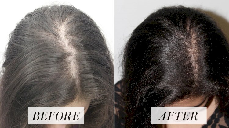 Why You Should Try Platelet-Rich Plasma (PRP) Treatment For Hair Loss Problem?