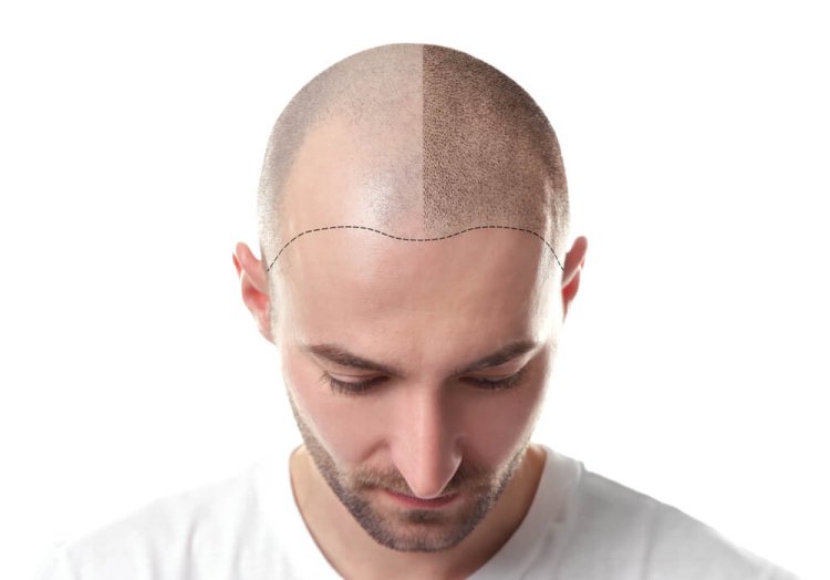 5 Points You Should Know About Hair Transplant 