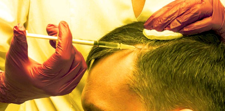 What Should You Know About PRP Treatment For Hair Loss?
