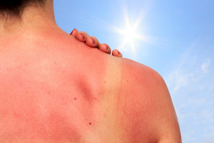 Is Your Sunburn So Serious?