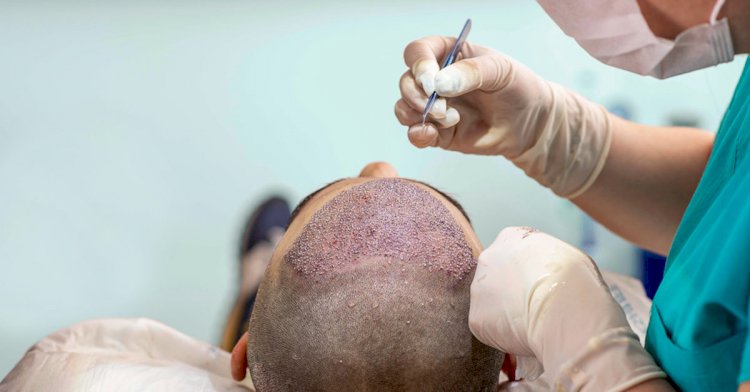Here Is All That You Need To Understand Surgical Hair Restoration – Part 2