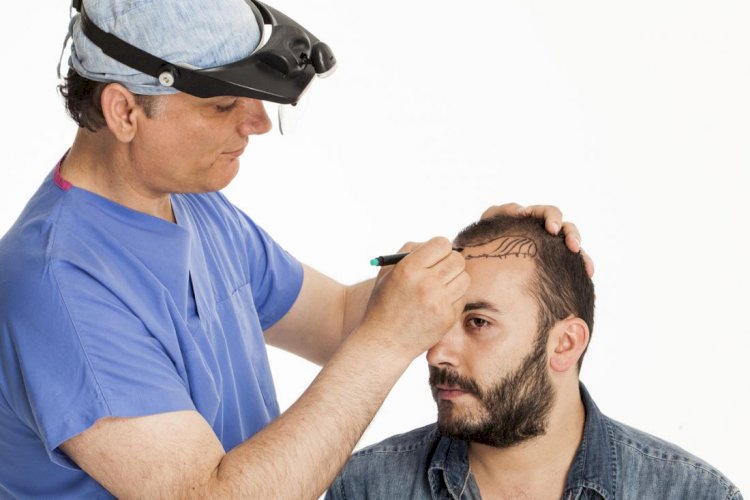 Tips For Speedy Recovery And Possible Complications After Hair Transplant 