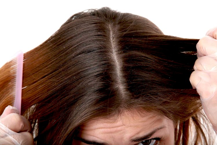 Poor hair and scalp health indicate an unhealthy body?