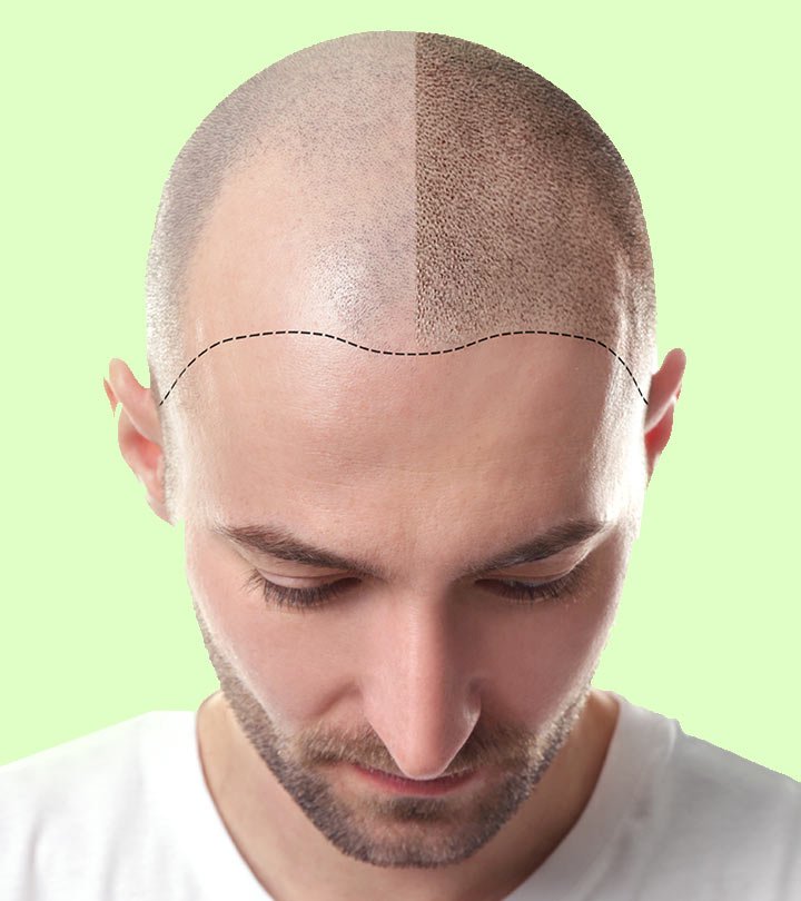 Ten Most Common Myths About Hair Transplantation