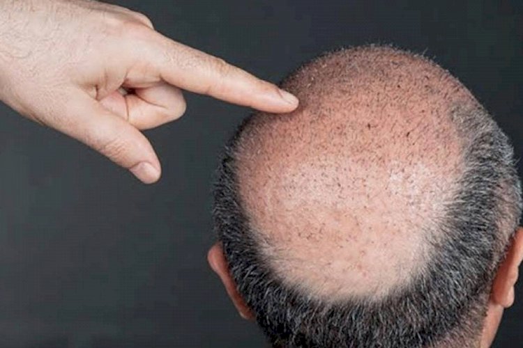 What To Expect From FUT Hair Transplant 