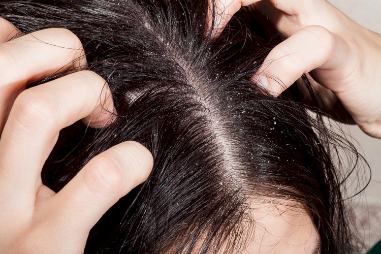 What Is The Link Between An Itchy Scalp And Hair Loss? - Part 2
