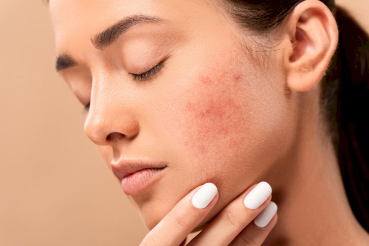 With This Report, We Underline The Dermatologist's Tips For Acne Scars