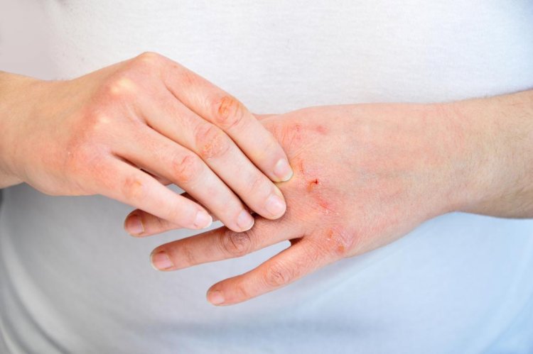 Here Are The Most Wanted Winter Psoriasis Tips