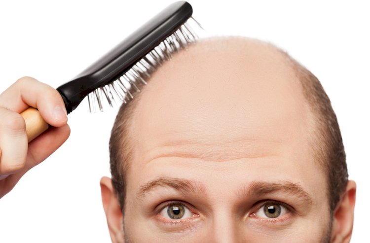 All About Hair Loss When It Is Caused By Hair Shaft Defects – Part 2