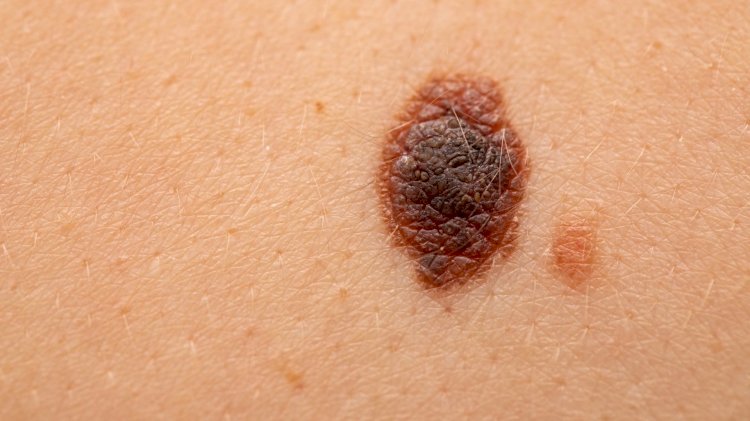What Are The Effective Treatments For Melanoma?