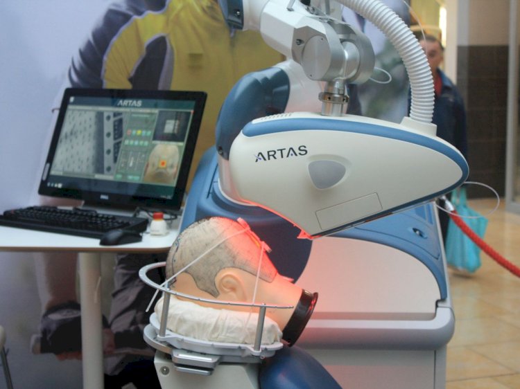 Helping Ease The Process Of Hair Transplant, Here Is Robot Hair-Transplant Device Getting FDA Nod
