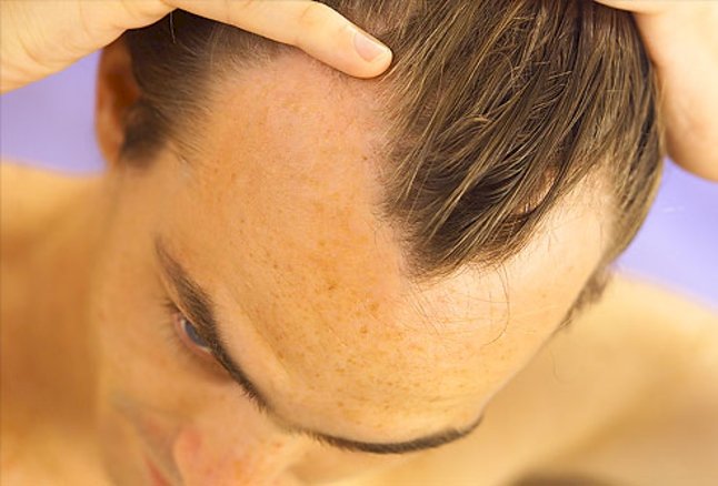 Do Know About All The Best Hair Loss Treatments For Men – Part 2